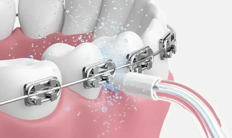 Насадки для ирригатора Oclean Nozzle for A10-Orthodontics 2 шт - фото - №4